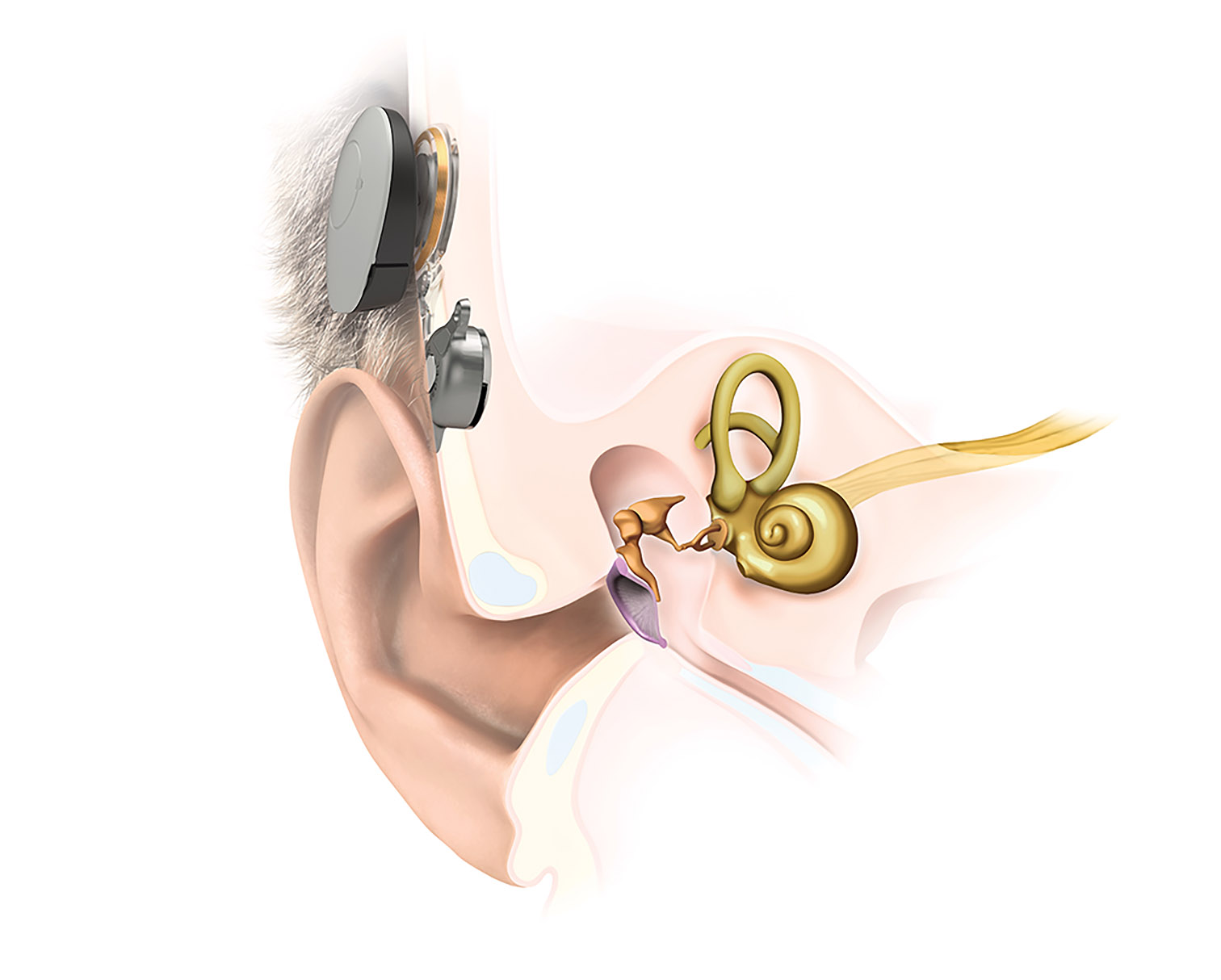 Bone Conduction Implants